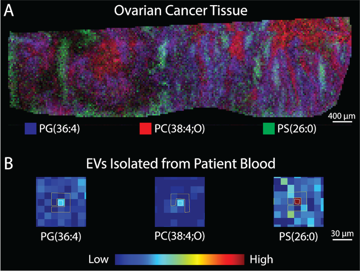 Fluorescence imagery of ovarian cancer tissue and a map of extracellular vesicles sources from patient blood